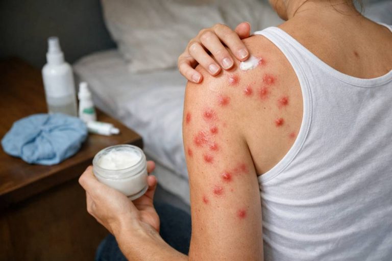 Comment soigner des piqûres de punaises de lit : gestes immédiats, traitements et conseils de prévention