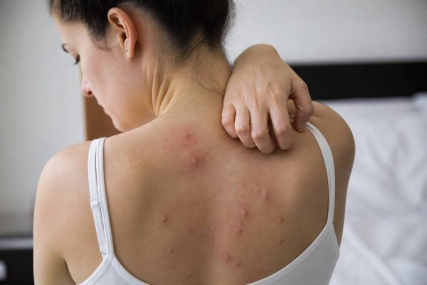 Allergie punaises de lit : symptômes, causes et solutions pour mieux réagir