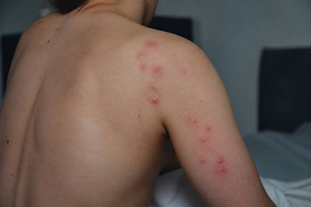 Comment reconnaitre une piqure de punaise de lit : signes et symptômes à connaître
