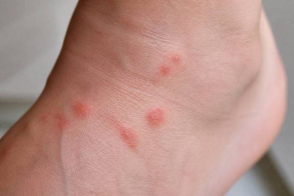 Piqure acarien : causes, symptômes et solutions pour soulager les démangeaisons