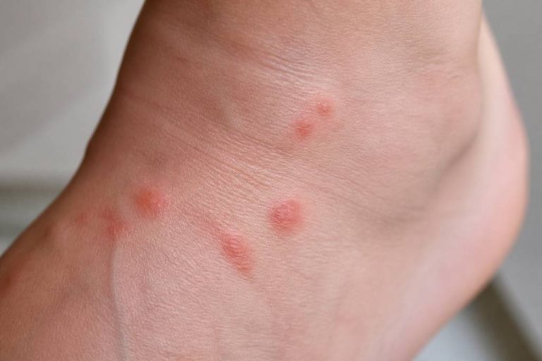 Piqure acarien : causes, symptômes et solutions pour soulager les démangeaisons