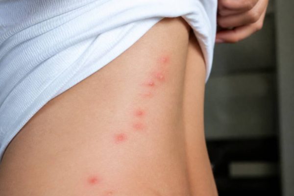 Comment reconnaitre des piqures de punaises de lit : signes, aspects et différences avec d’autres piqûres