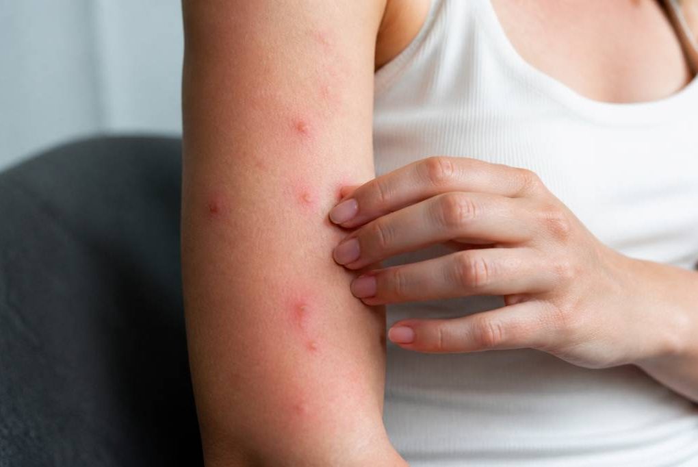 A quoi ressemble piqure punaise de lit ?